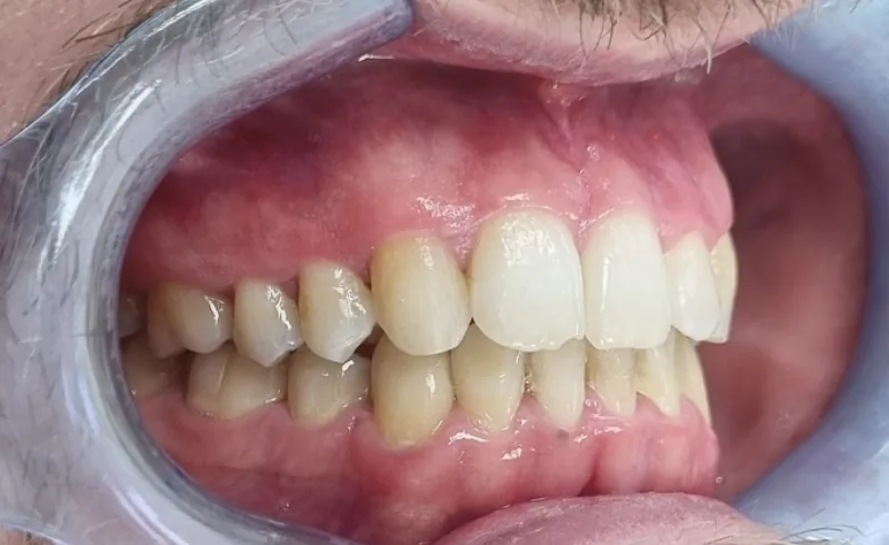 After treatment: upper front teeth straightened