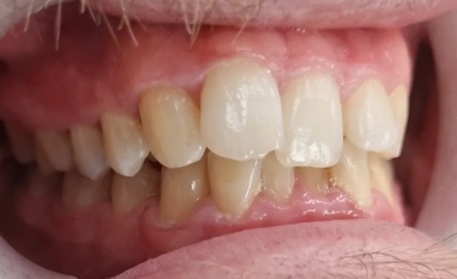 Before treatment: upper front teeth slightly out of line