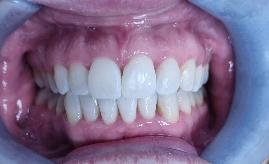 After treatment: straight, brighter upper and lower teeth