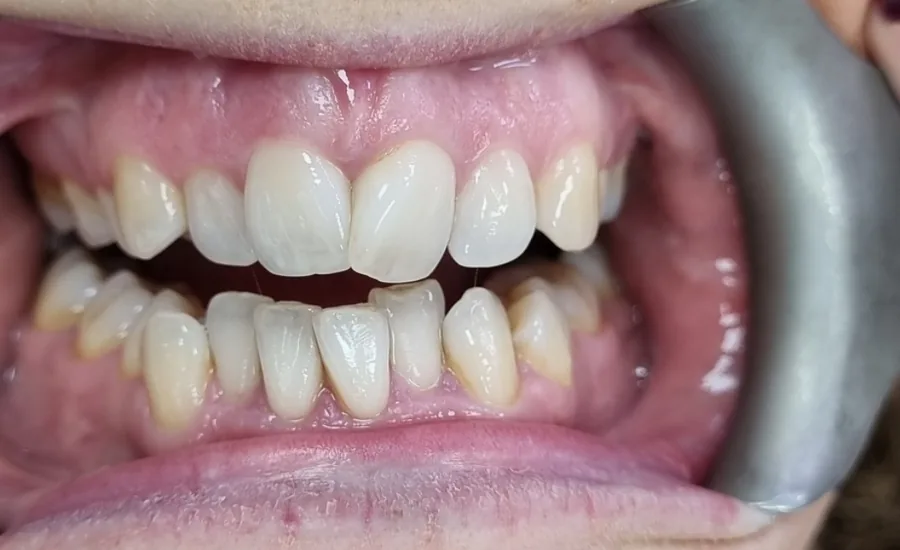 Before treatment: crowded and discoloured lower teeth